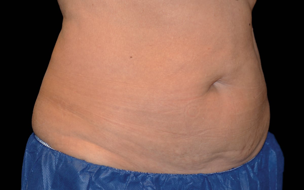 after image of coolsculpting session at celebrity med spa