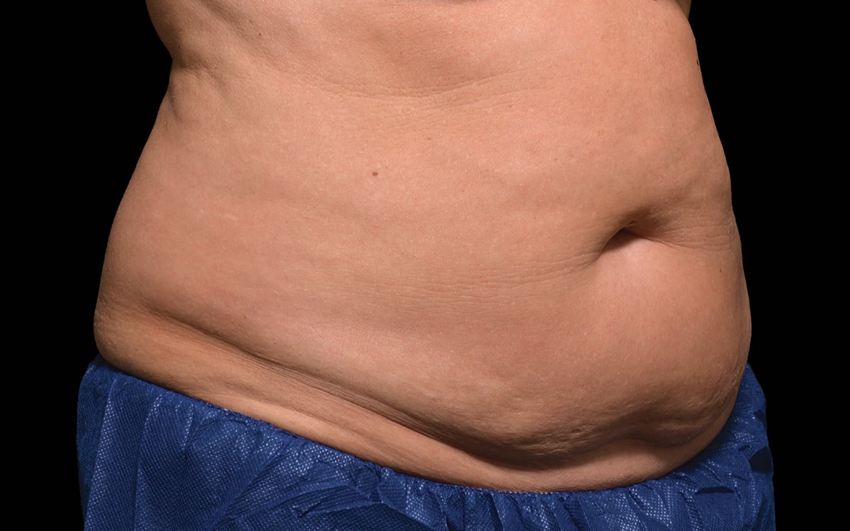 before image of coolsculpting session at celebrity med spa