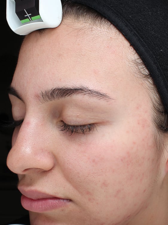 after image of vi peels at celebrity med spa