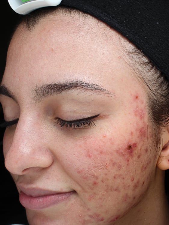 before image of vi peels at celebrity med spa
